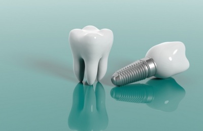 Что нужно знать перед имплантацией зубов - ликбез для пациента