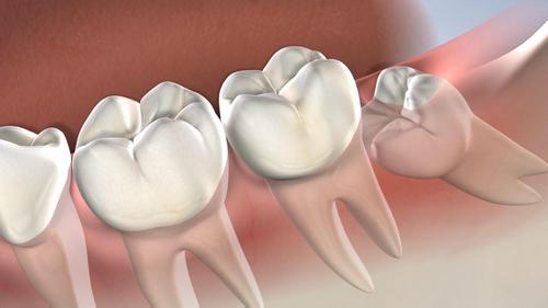 Удаление восьмых зубов